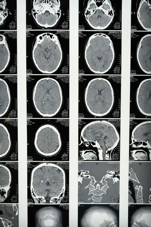 pexels-cottonbro-studio-5723875 Can You Live A Normal Life After Brain Injury?